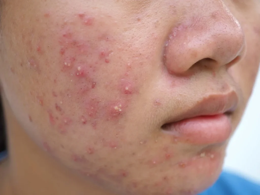 paciente adolescente com acne em face papulo-pustular.