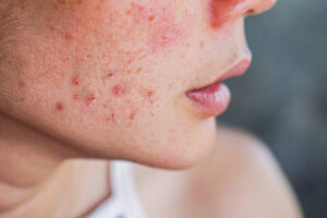 Acne tem tratamento