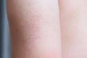 ceratose pilar braços - tratamento dermatologista Curitiba