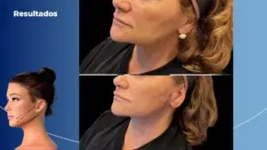 Fios aptos para o contorno facial