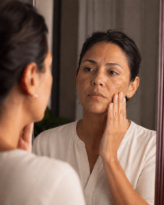 Mulher com melasma nas maçãs do rosto e no buço observa a própria pele no espelho, em Curitiba.